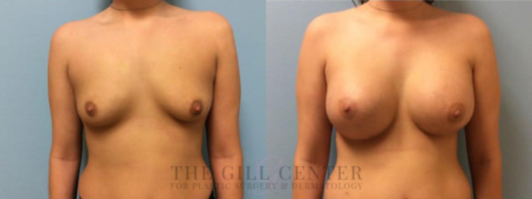 Breast Augmentation Case 48 Before & After Front | Shenandoah, TX | The Gill Center for Plastic Surgery and Dermatology