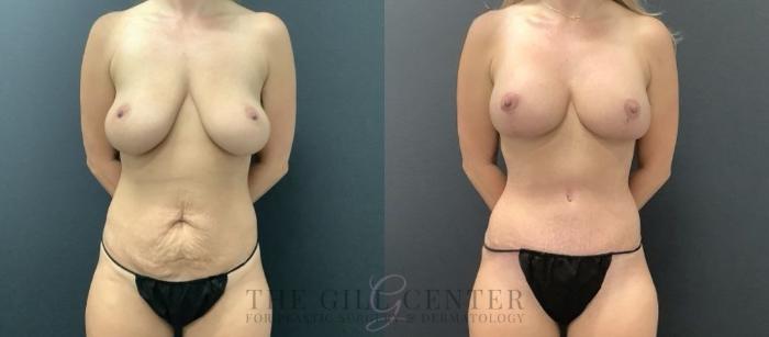 Liposuction Case 712 Before & After Front | The Woodlands, TX | The Gill Center for Plastic Surgery and Dermatology