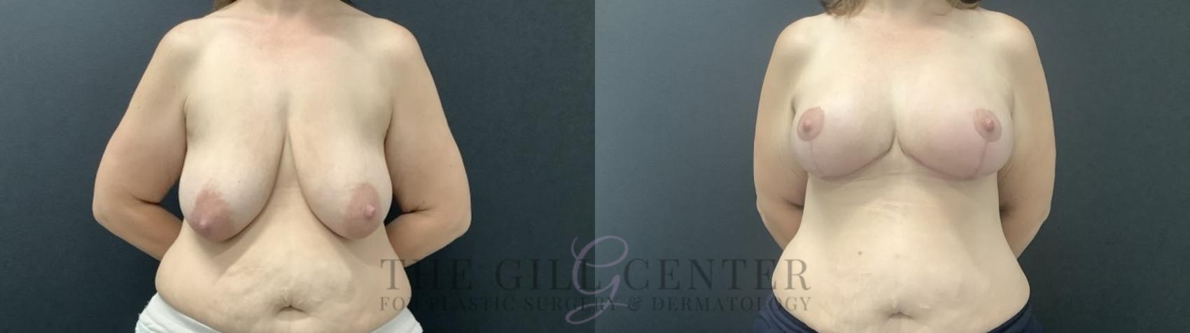 Breast Augmentation Case 714 Before & After Front | The Woodlands, TX | The Gill Center for Plastic Surgery and Dermatology