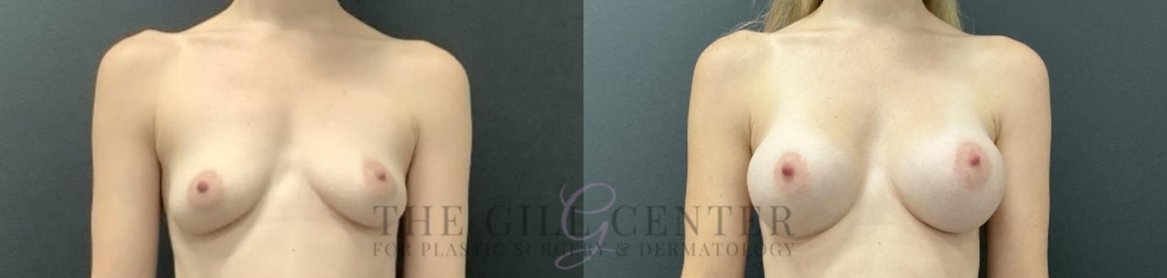 Breast Augmentation Case 725 Before & After Front | The Woodlands, TX | The Gill Center for Plastic Surgery and Dermatology