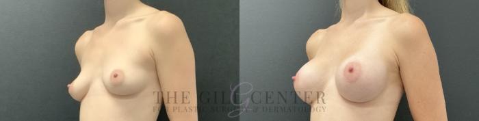 Breast Augmentation Case 725 Before & After Left Oblique | The Woodlands, TX | The Gill Center for Plastic Surgery and Dermatology
