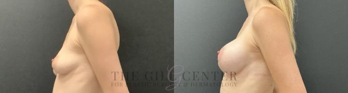 Breast Augmentation Case 725 Before & After Left Side | The Woodlands, TX | The Gill Center for Plastic Surgery and Dermatology
