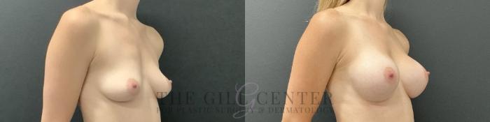 Breast Augmentation Case 725 Before & After Right Oblique | The Woodlands, TX | The Gill Center for Plastic Surgery and Dermatology