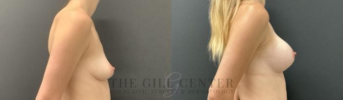Breast Augmentation Case 725 Before & After Right Side | The Woodlands, TX | The Gill Center for Plastic Surgery and Dermatology