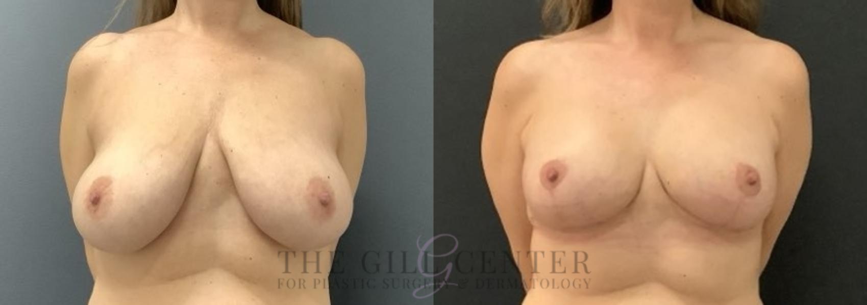 Breast Lift Case 688 Before & After Front | The Woodlands, TX | The Gill Center for Plastic Surgery and Dermatology