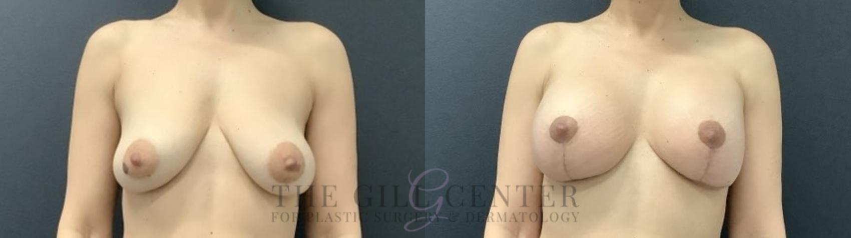 Breast Lift with Implants Case 707 Before & After Front | The Woodlands, TX | The Gill Center for Plastic Surgery and Dermatology