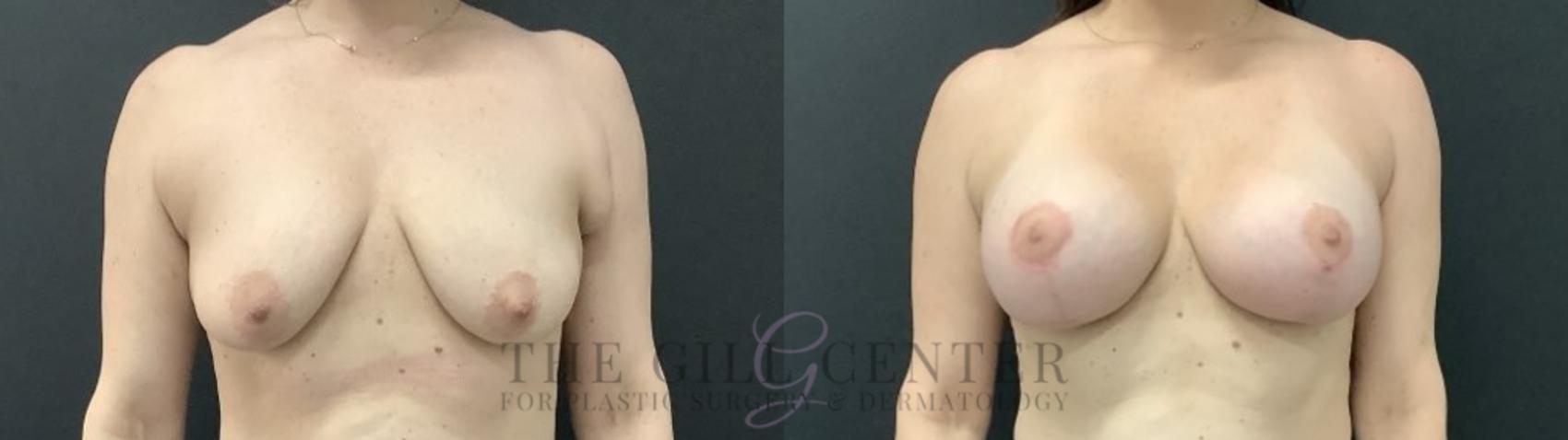 Breast Lift with Implants Case 708 Before & After Front | The Woodlands, TX | The Gill Center for Plastic Surgery and Dermatology