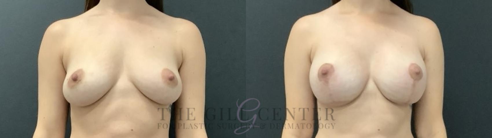 Breast Lift with Implants Case 710 Before & After Front | The Woodlands, TX | The Gill Center for Plastic Surgery and Dermatology