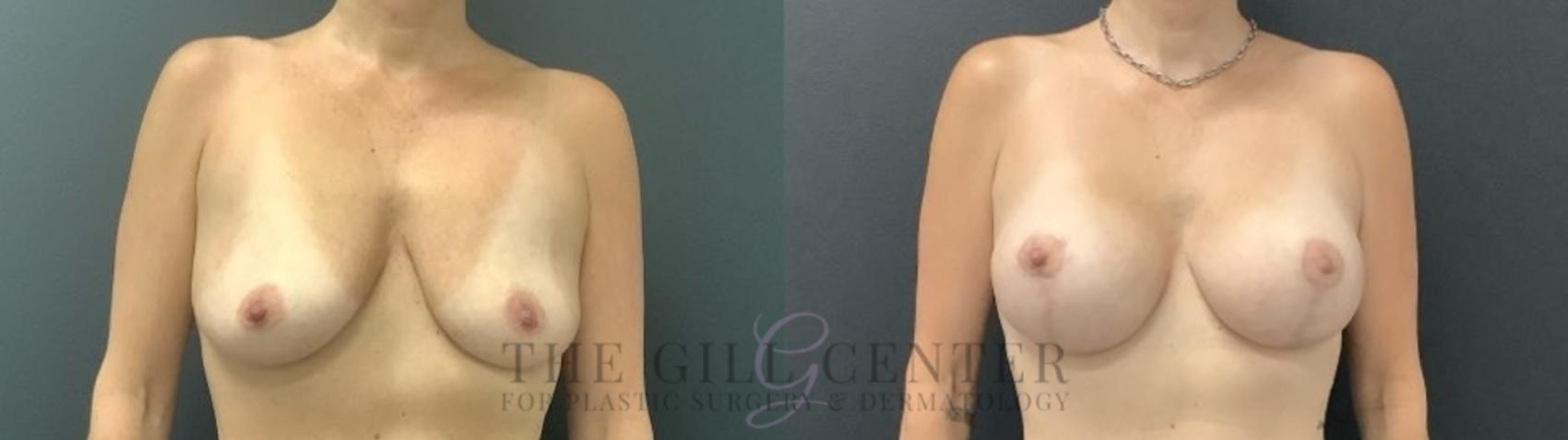 Breast Lift with Implants Case 711 Before & After Front | The Woodlands, TX | The Gill Center for Plastic Surgery and Dermatology