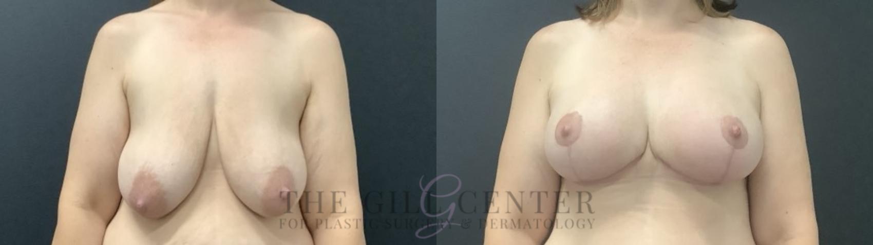 Breast Lift with Implants Case 714 Before & After Front | The Woodlands, TX | The Gill Center for Plastic Surgery and Dermatology
