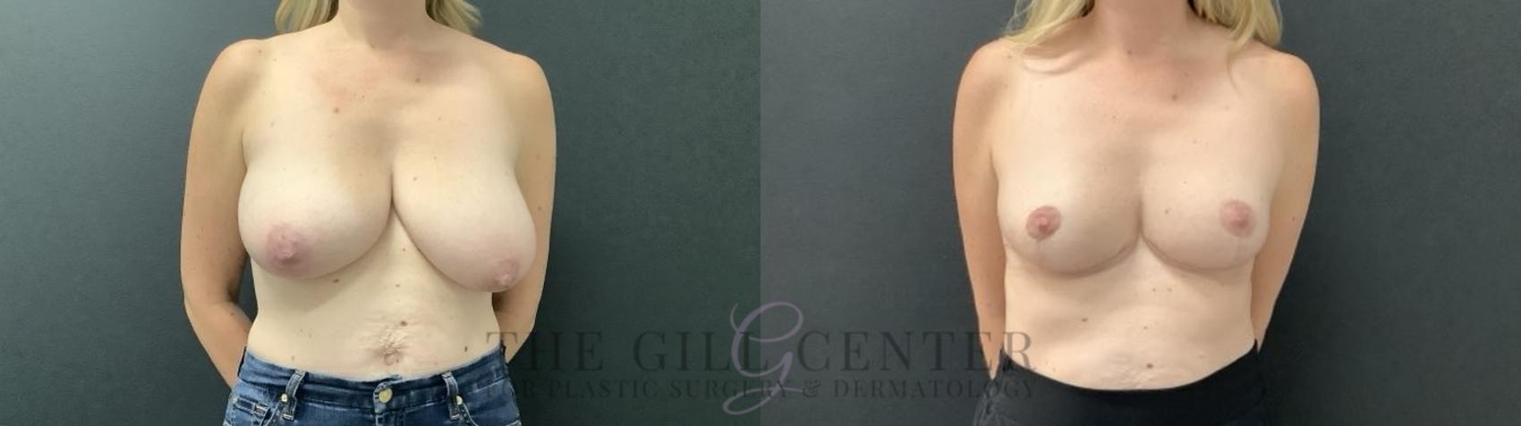 Breast Reduction Case 700 Before & After Front | The Woodlands, TX | The Gill Center for Plastic Surgery and Dermatology