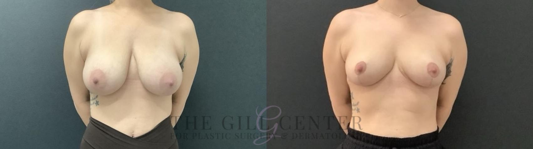 Breast Reduction Case 702 Before & After Front | The Woodlands, TX | The Gill Center for Plastic Surgery and Dermatology