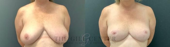 Breast Reduction Case 749 Before & After Front | The Woodlands, TX | The Gill Center for Plastic Surgery and Dermatology