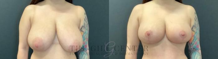 Breast Reduction Case 750 Before & After Front | The Woodlands, TX | The Gill Center for Plastic Surgery and Dermatology