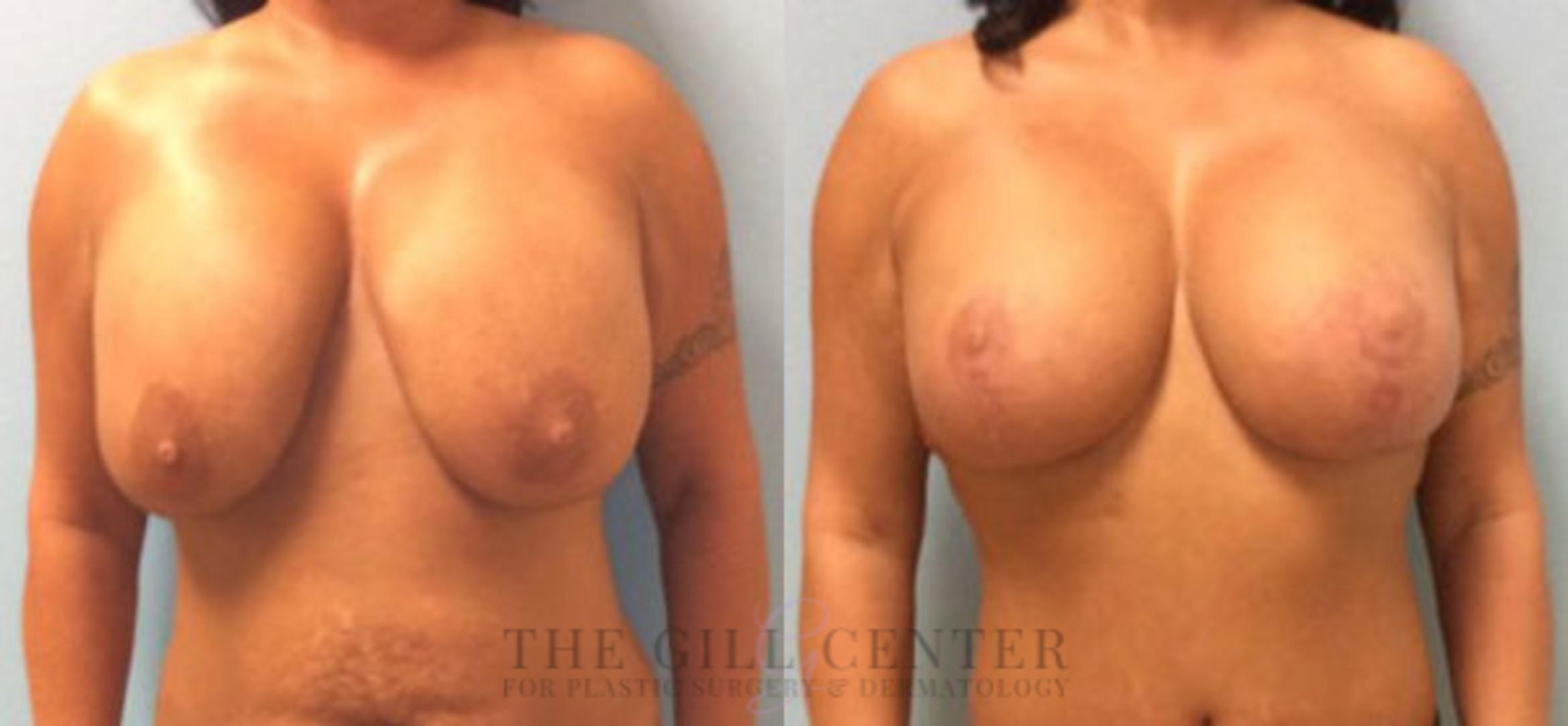 Breast Revision Case 375 Before & After Front | The Woodlands, TX | The Gill Center for Plastic Surgery and Dermatology