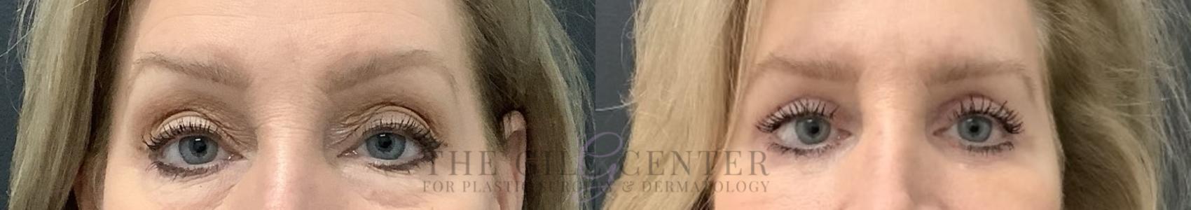Eyelid Lift Case 705 Before & After Front | The Woodlands, TX | The Gill Center for Plastic Surgery and Dermatology