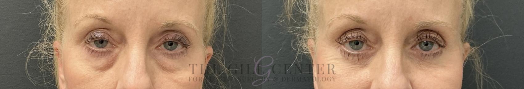Eyelid Lift Case 781 Before & After Front | The Woodlands, TX | The Gill Center for Plastic Surgery and Dermatology