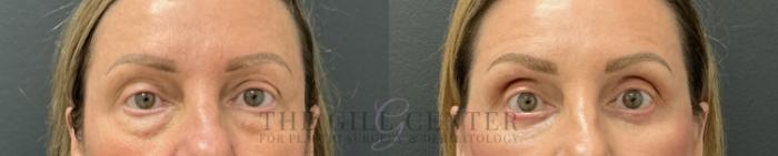 Eyelid Lift Case 801 Before & After Front | The Woodlands, TX | The Gill Center for Plastic Surgery and Dermatology