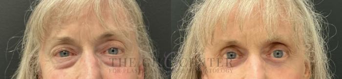 Eyelid Lift Case 812 Before & After Front | The Woodlands, TX | The Gill Center for Plastic Surgery and Dermatology