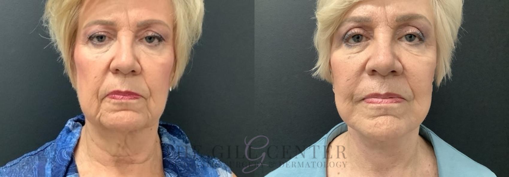 Face & Neck Lift Case 689 Before & After Front | The Woodlands, TX | The Gill Center for Plastic Surgery and Dermatology