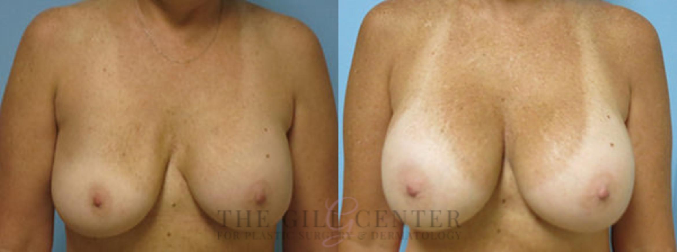 Breast Revision Case 352 Before & After Front | The Woodlands, TX | The Gill Center for Plastic Surgery and Dermatology