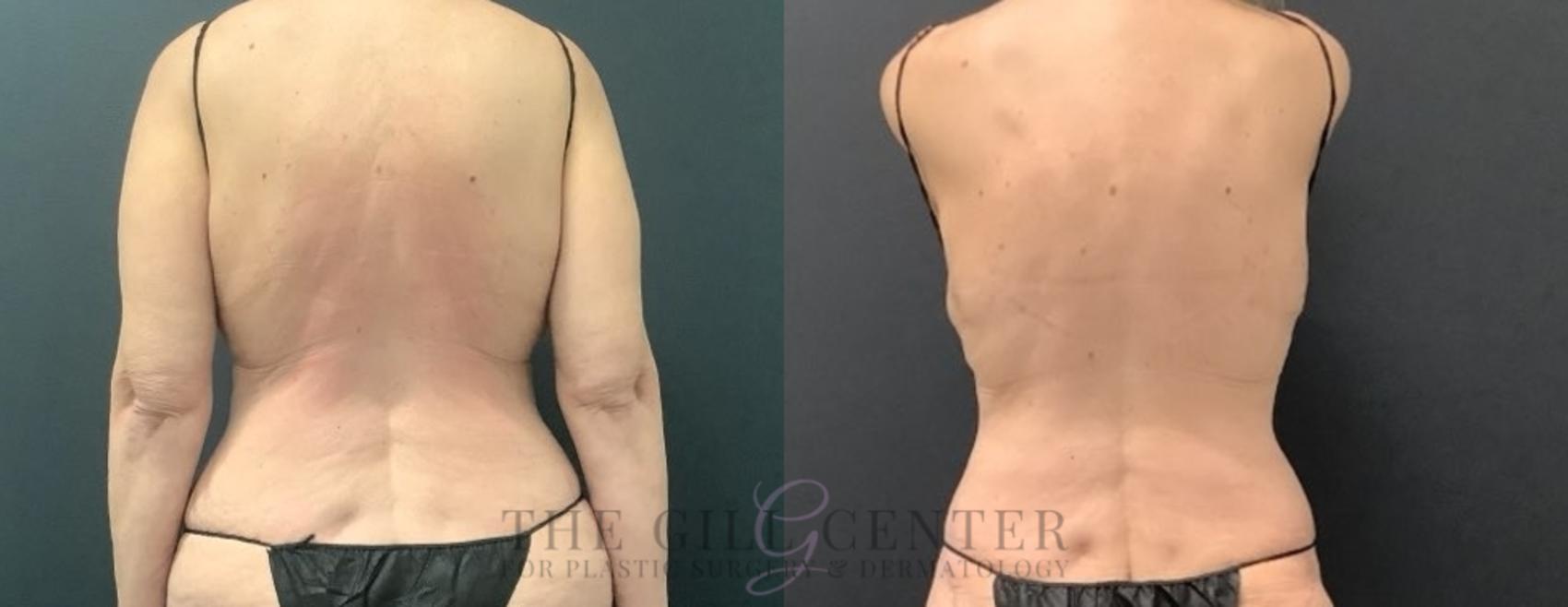 Liposuction Case 718 Before & After Back | The Woodlands, TX | The Gill Center for Plastic Surgery and Dermatology