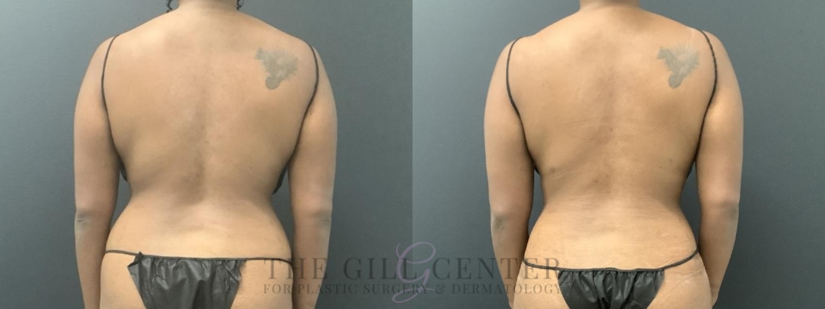 Liposuction Case 722 Before & After Back | The Woodlands, TX | The Gill Center for Plastic Surgery and Dermatology