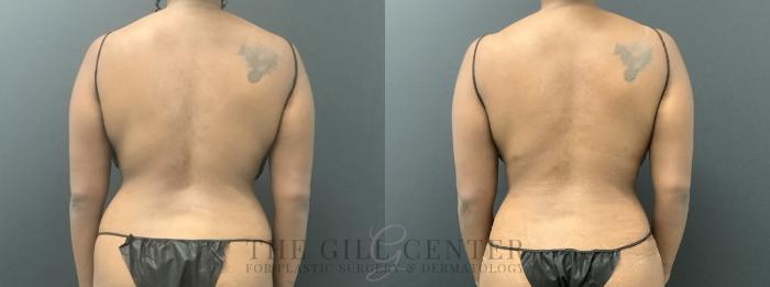 Liposuction Case 722 Before & After Back | The Woodlands, TX | The Gill Center for Plastic Surgery and Dermatology