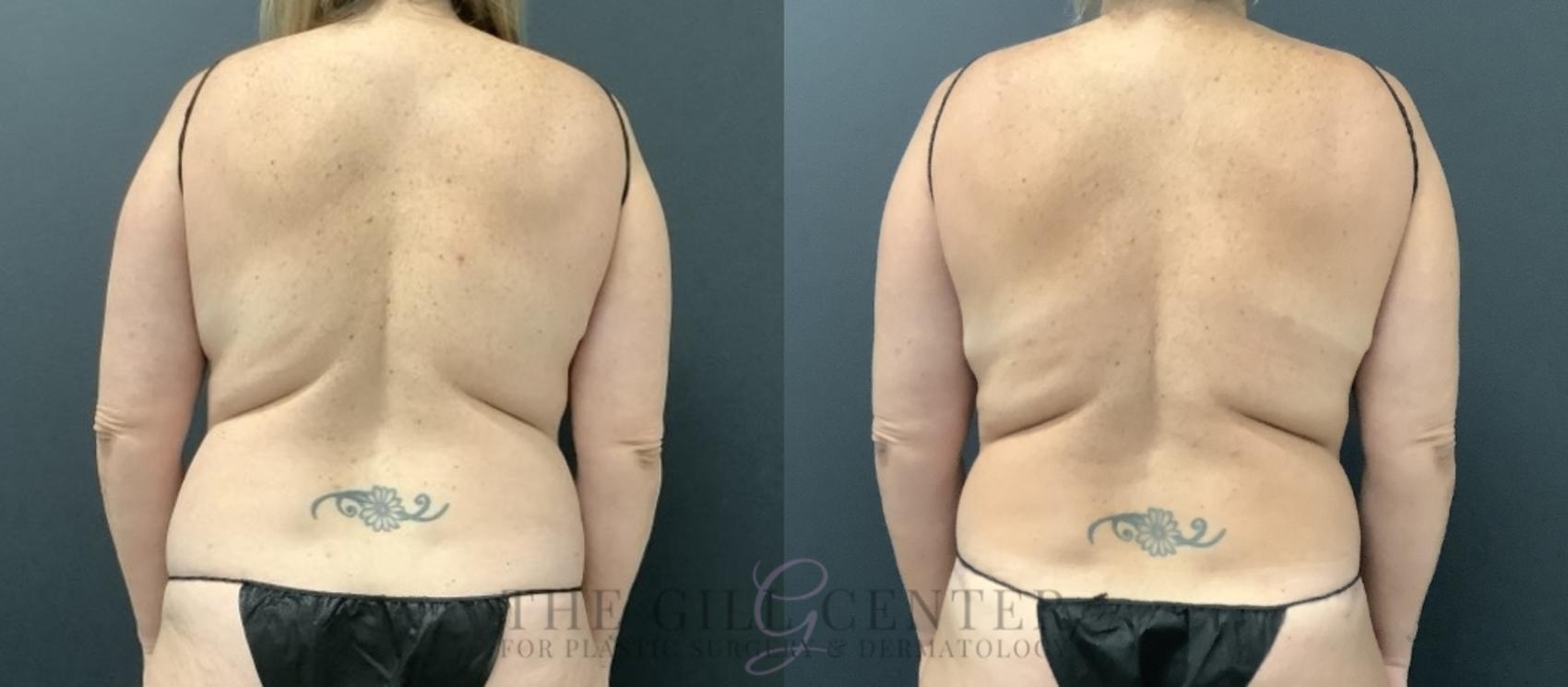 Liposuction Case 730 Before & After Back | The Woodlands, TX | The Gill Center for Plastic Surgery and Dermatology