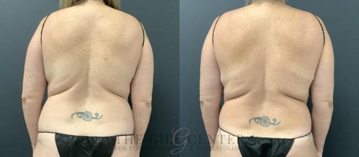Liposuction Case 730 Before & After Back | The Woodlands, TX | The Gill Center for Plastic Surgery and Dermatology