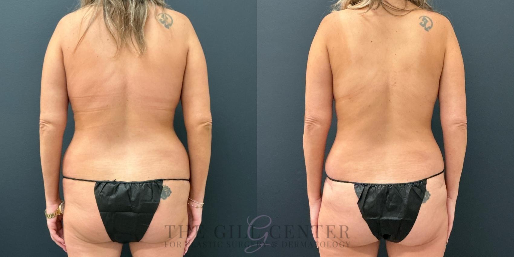 Liposuction Case 771 Before & After Back | The Woodlands, TX | The Gill Center for Plastic Surgery and Dermatology