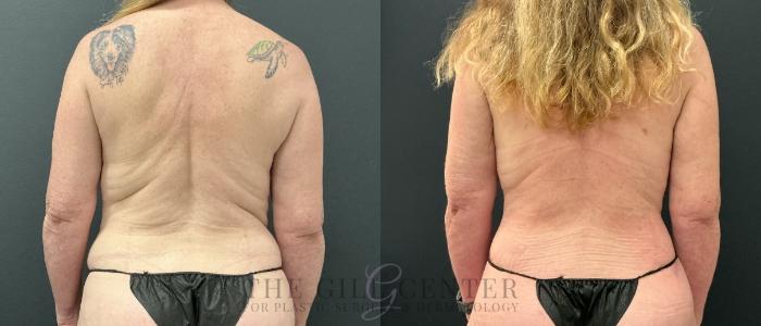 Liposuction Case 774 Before & After Back | The Woodlands, TX | The Gill Center for Plastic Surgery and Dermatology