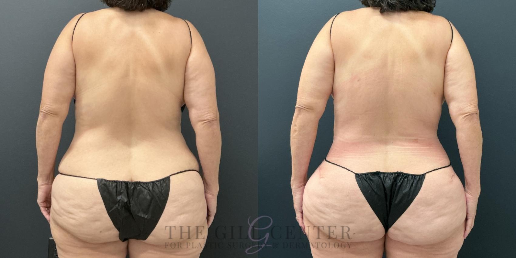 Liposuction Case 780 Before & After Back | The Woodlands, TX | The Gill Center for Plastic Surgery and Dermatology