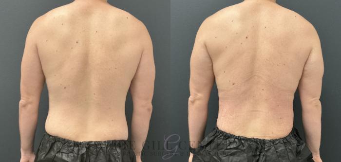 Liposuction Case 806 Before & After Back | The Woodlands, TX | The Gill Center for Plastic Surgery and Dermatology