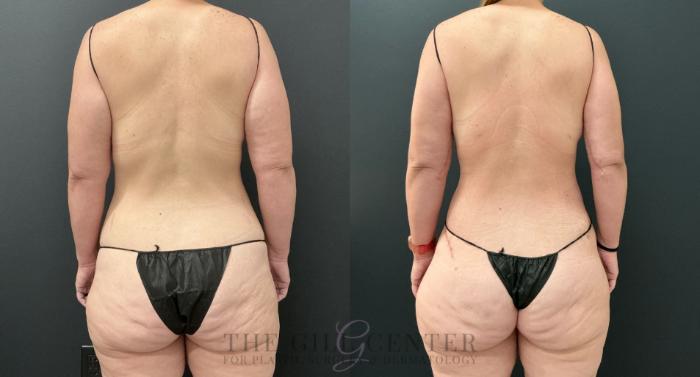 Liposuction Case 810 Before & After Back | The Woodlands, TX | The Gill Center for Plastic Surgery and Dermatology