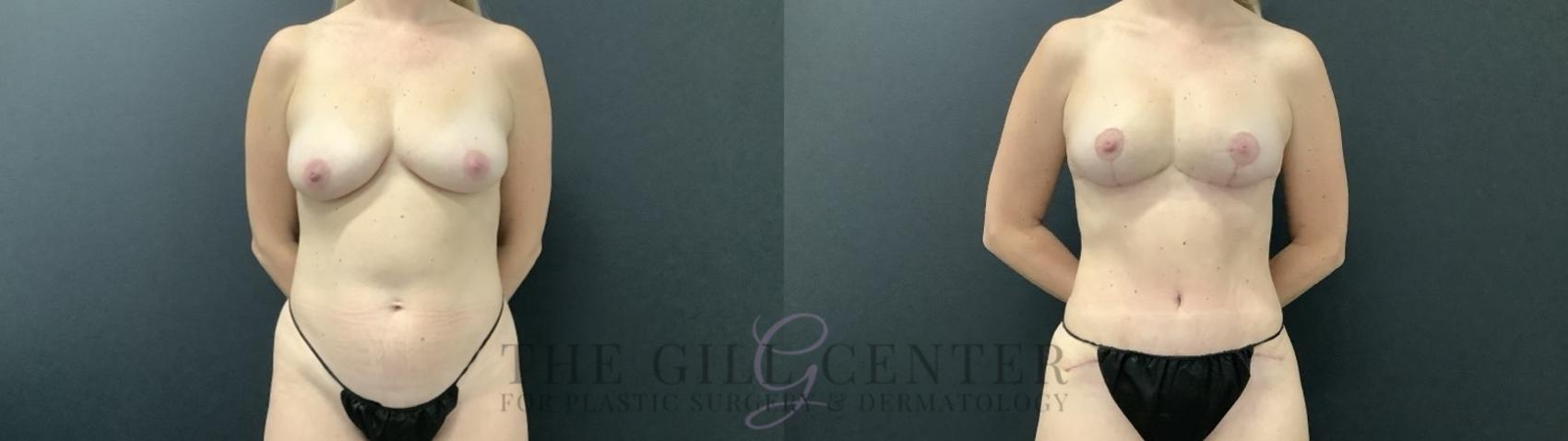 Mommy Makeover Case 686 Before & After Front | The Woodlands, TX | The Gill Center for Plastic Surgery and Dermatology