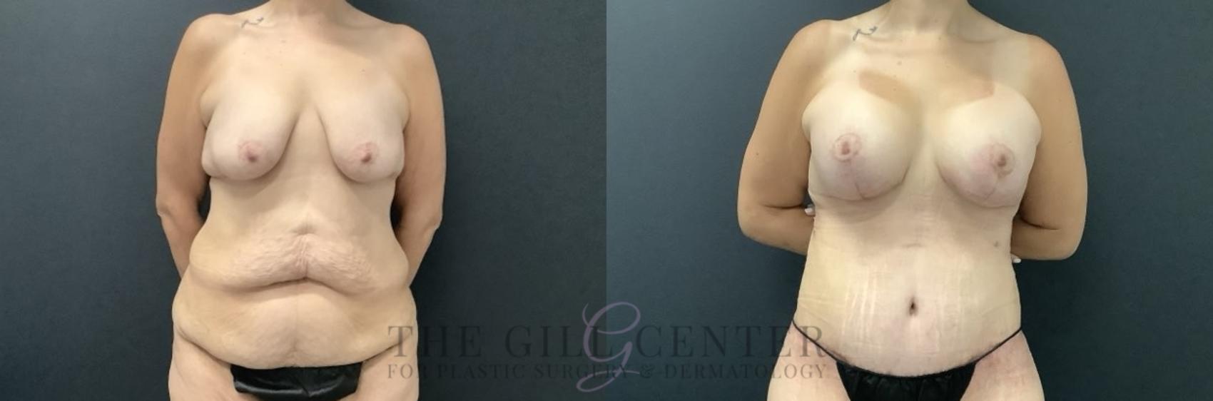 Mommy Makeover Case 696 Before & After Front | The Woodlands, TX | The Gill Center for Plastic Surgery and Dermatology