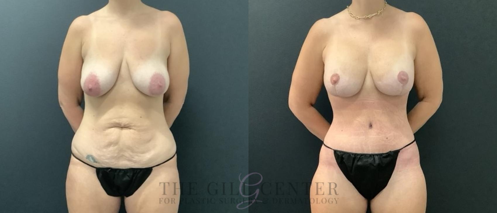 Mommy Makeover Case 703 Before & After Front | The Woodlands, TX | The Gill Center for Plastic Surgery and Dermatology