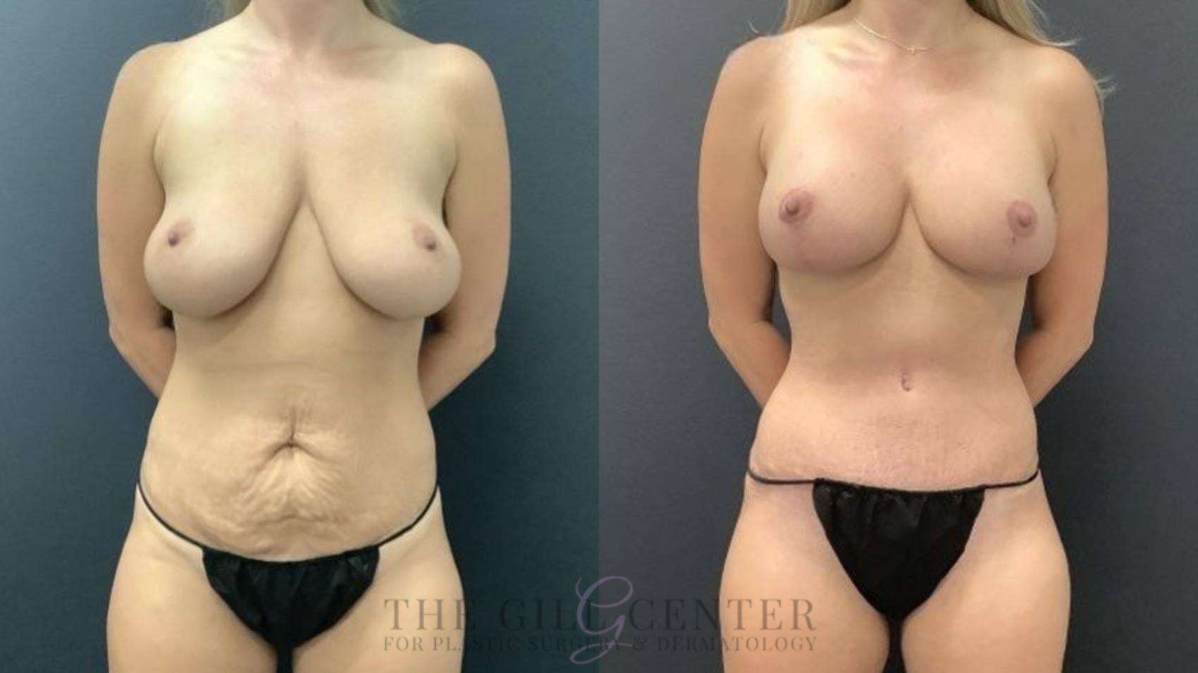 Mommy Makeover Case 712 Before & After Front | The Woodlands, TX | The Gill Center for Plastic Surgery and Dermatology