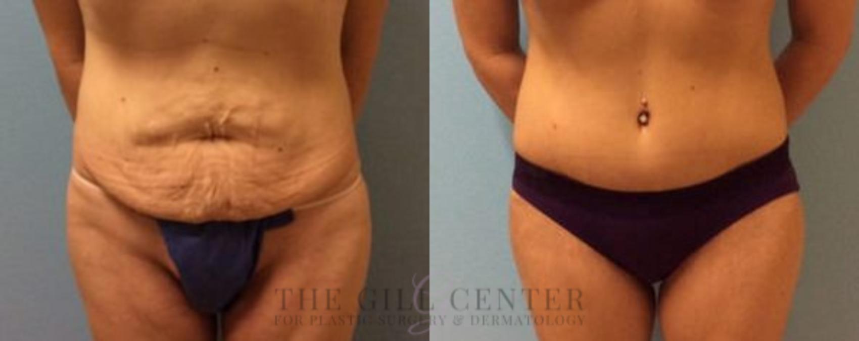 Tummy Tuck Case 190 Before & After Front | Shenandoah, TX | The Gill Center for Plastic Surgery and Dermatology