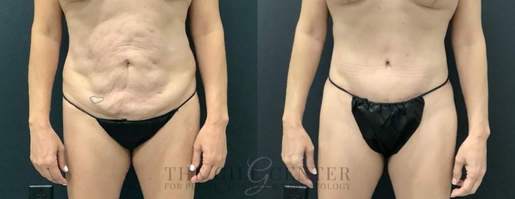 Tummy Tuck Case 674 Before & After Front | The Woodlands, TX | The Gill Center for Plastic Surgery and Dermatology