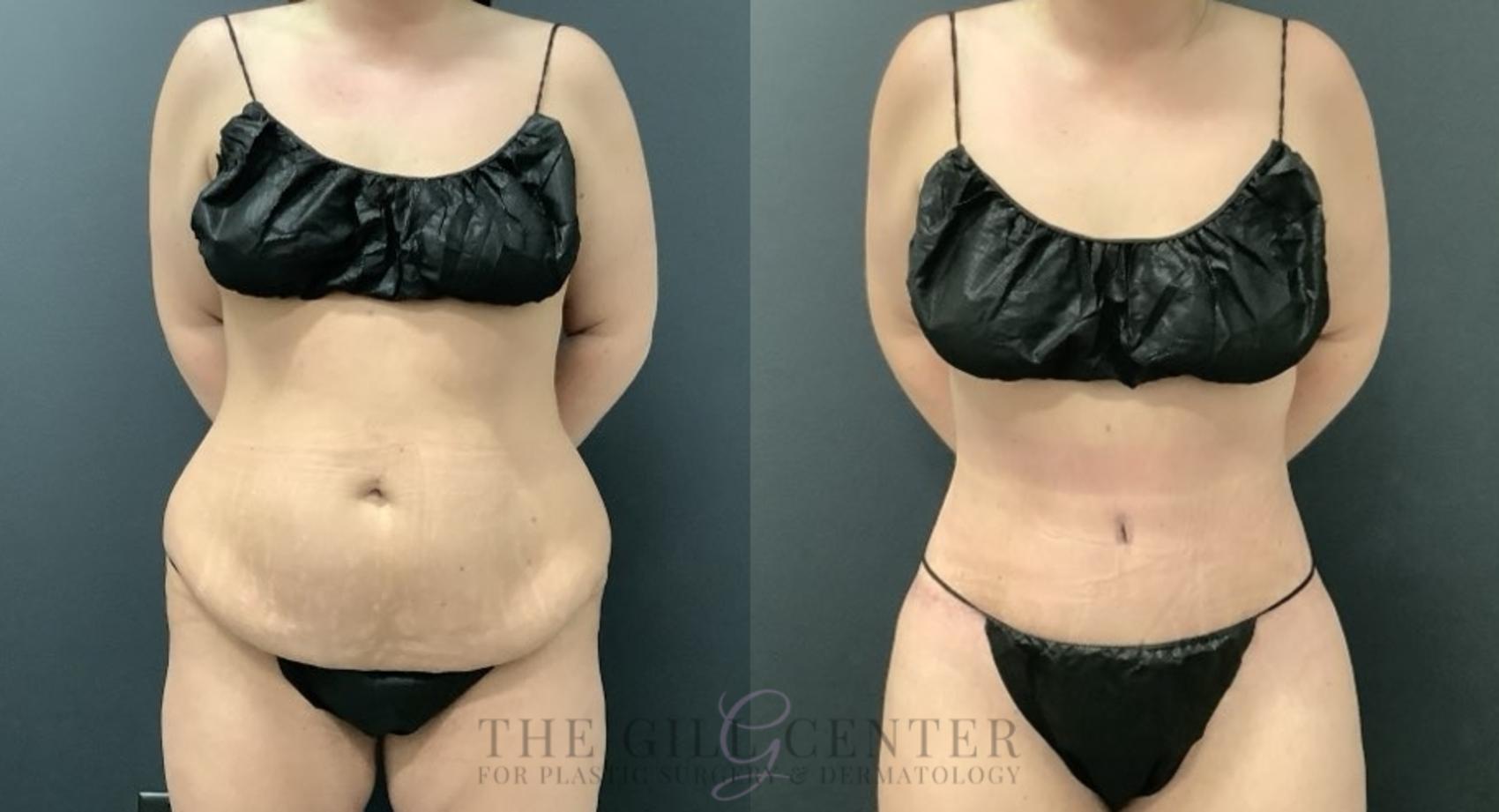 Tummy Tuck Case 683 Before & After Front | The Woodlands, TX | The Gill Center for Plastic Surgery and Dermatology