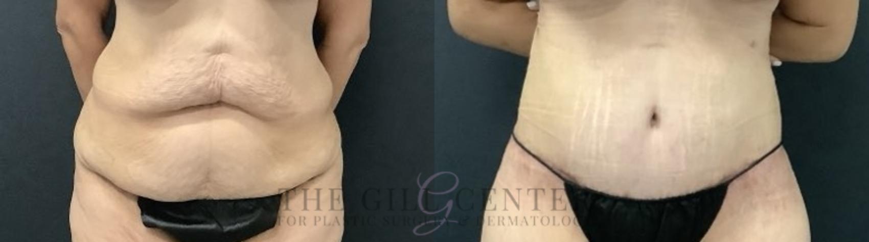 Tummy Tuck Case 696 Before & After Front | The Woodlands, TX | The Gill Center for Plastic Surgery and Dermatology