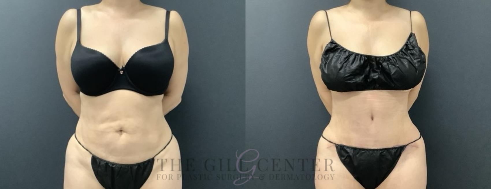 Tummy Tuck Case 697 Before & After Front | The Woodlands, TX | The Gill Center for Plastic Surgery and Dermatology