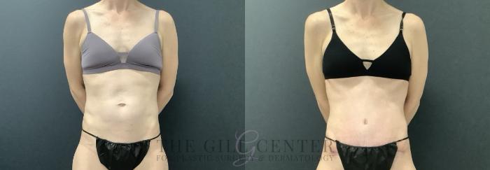 Liposuction Case 698 Before & After Front | The Woodlands, TX | The Gill Center for Plastic Surgery and Dermatology