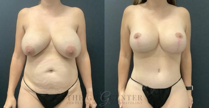 Liposuction Case 715 Before & After Front | The Woodlands, TX | The Gill Center for Plastic Surgery and Dermatology