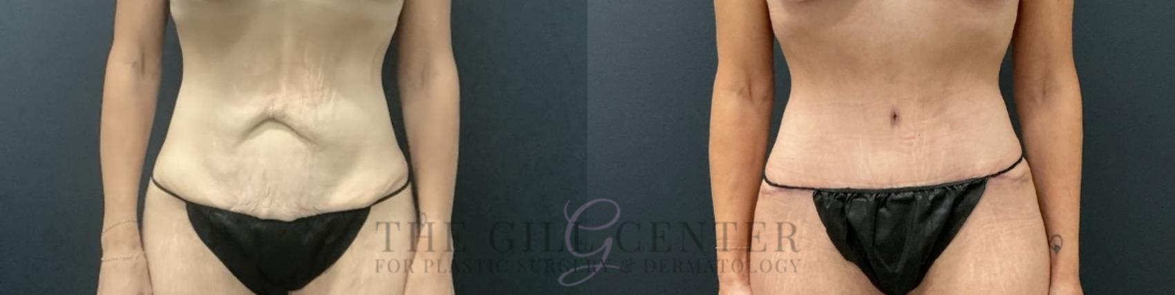 Tummy Tuck Case 723 Before & After Front | The Woodlands, TX | The Gill Center for Plastic Surgery and Dermatology