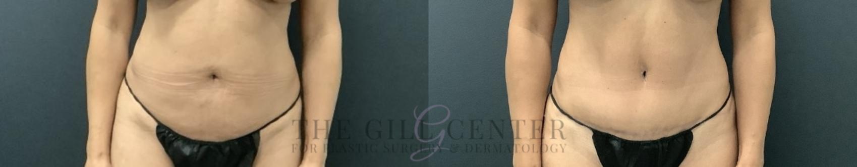 Tummy Tuck Case 727 Before & After Front | The Woodlands, TX | The Gill Center for Plastic Surgery and Dermatology