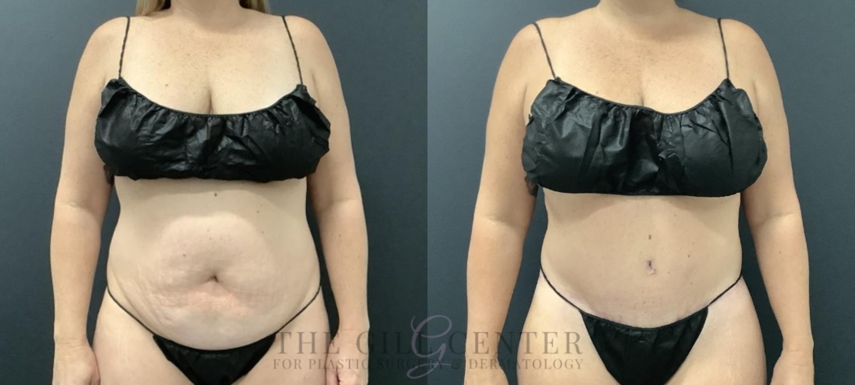 Tummy Tuck Case 729 Before & After Front | The Woodlands, TX | The Gill Center for Plastic Surgery and Dermatology