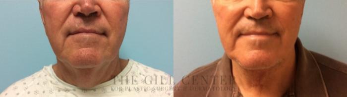  Male T-Z-Plasty Case 505 Before & After Front | The Woodlands, TX | The Gill Center for Plastic Surgery and Dermatology